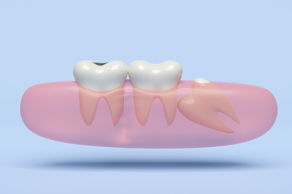 mitos verdades dentes siso